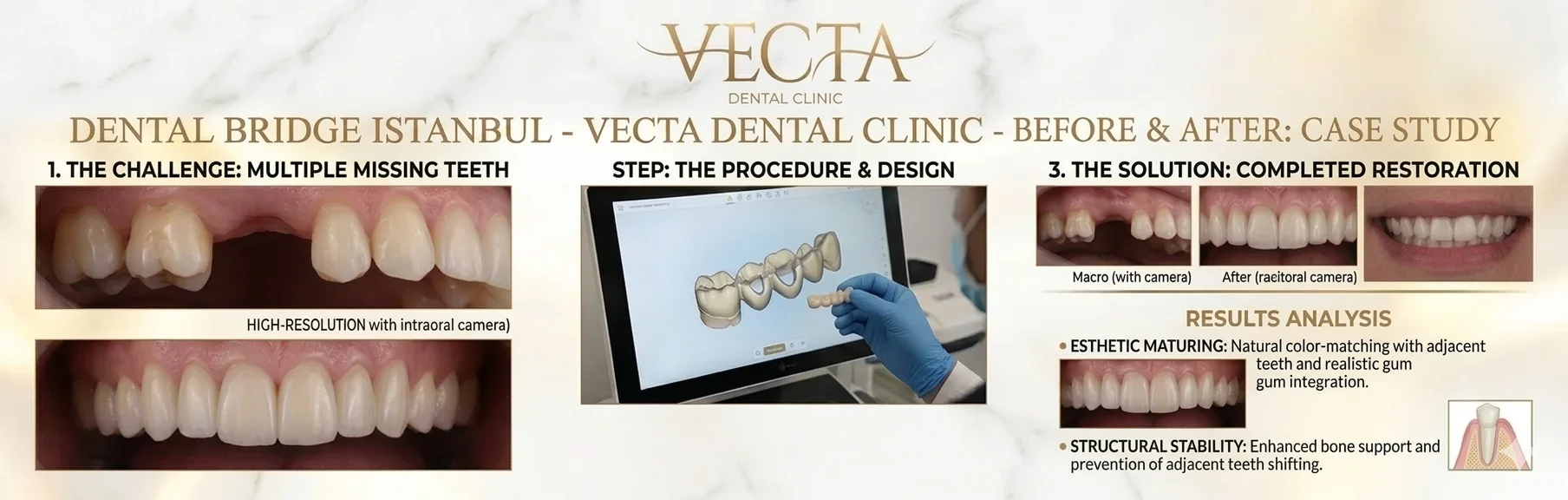 Premium dental bridge restoration at Vecta Dental Clinic Istanbul